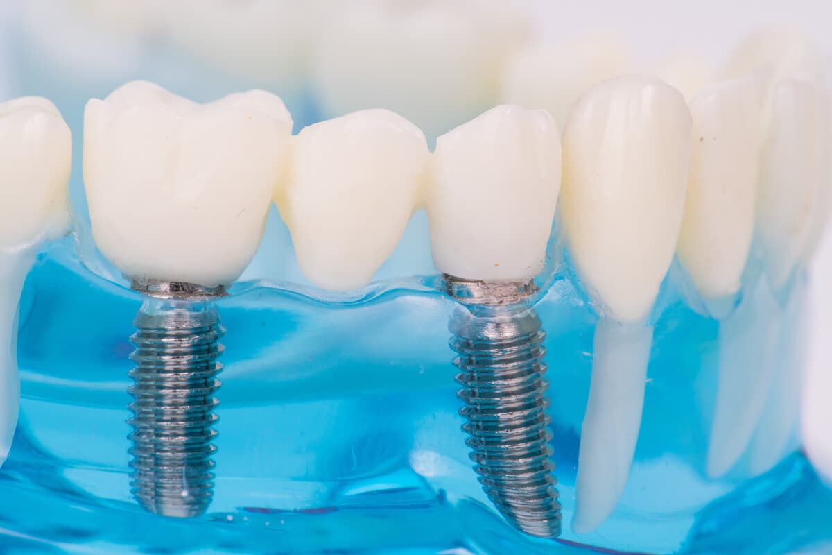 Injerto óseo dental en Teo