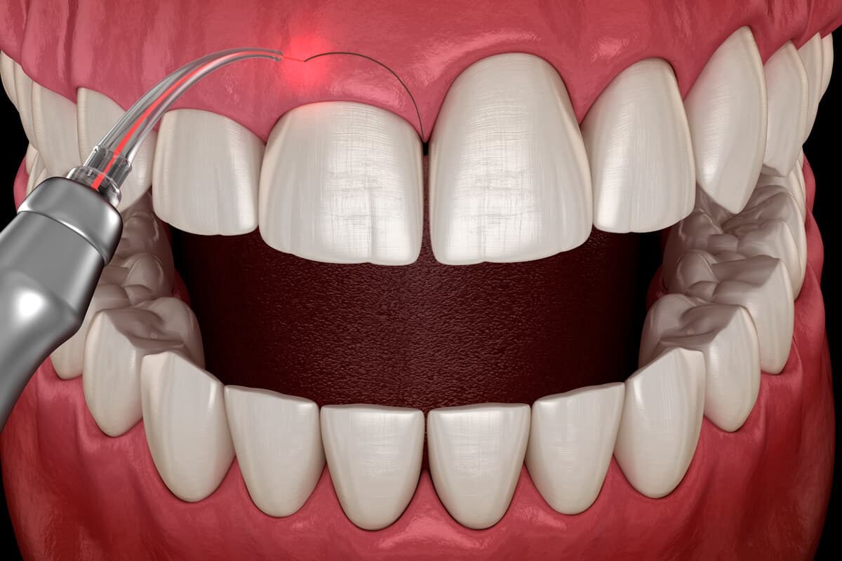 Láser de diodo en cirugía dental