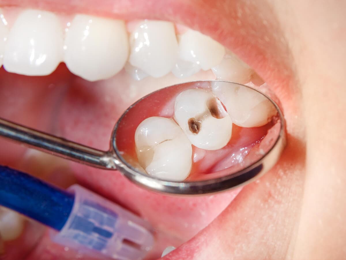 Pulpotomía en clínica dental