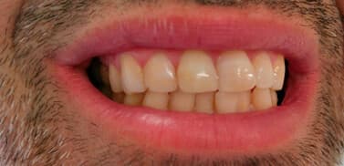Estética dental después de la intervención