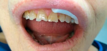 Odontología restauradora antes de la intervención