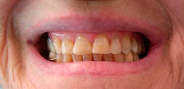 Odontología restauradora después  de la intervención