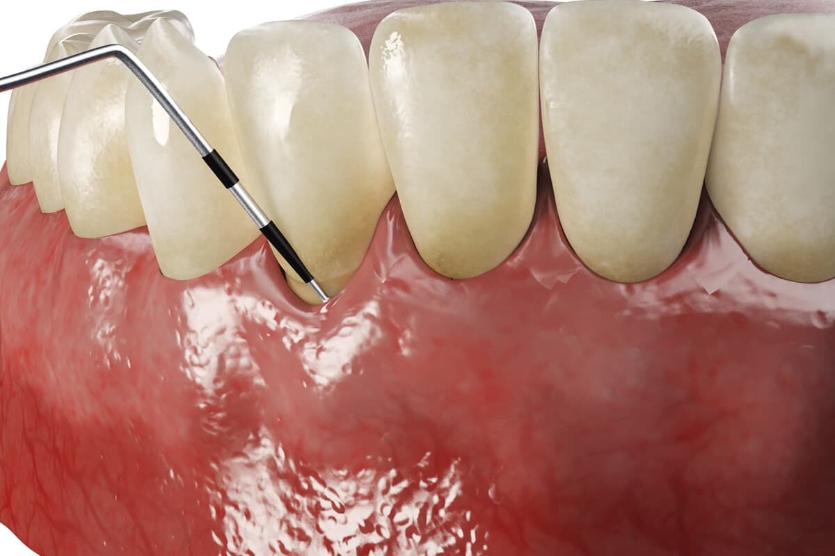 Tratar enfermedades periodontales